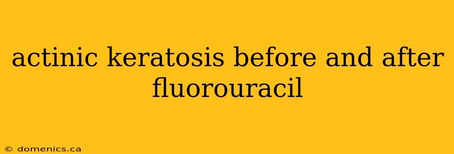 actinic keratosis before and after fluorouracil