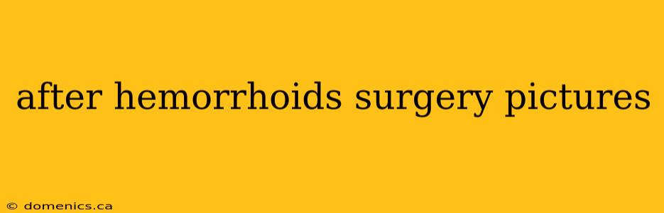 after hemorrhoids surgery pictures