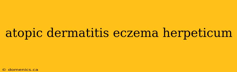 atopic dermatitis eczema herpeticum