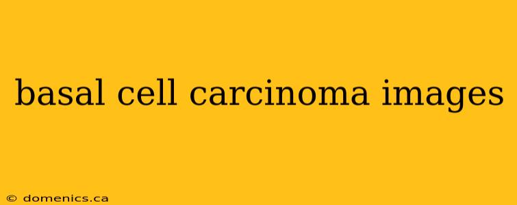 basal cell carcinoma images