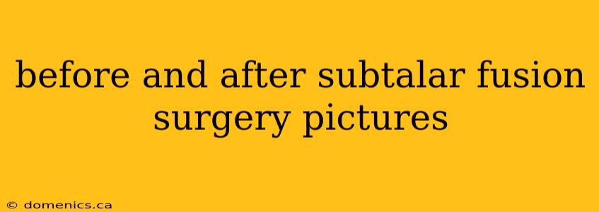 before and after subtalar fusion surgery pictures