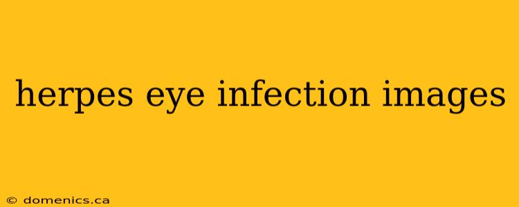 herpes eye infection images