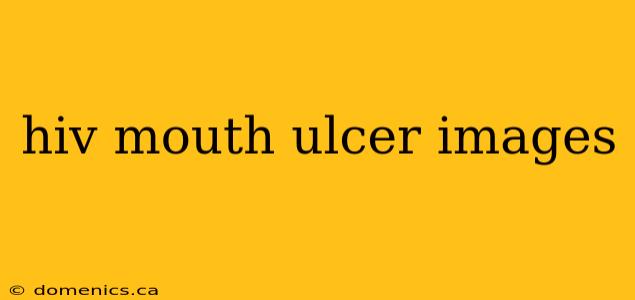 hiv mouth ulcer images