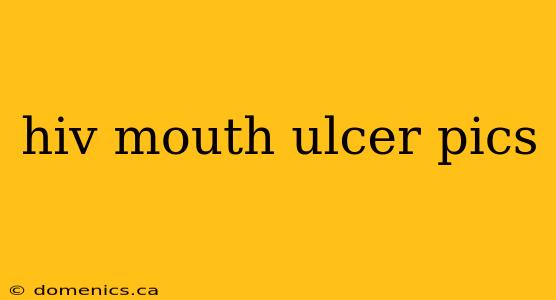 hiv mouth ulcer pics