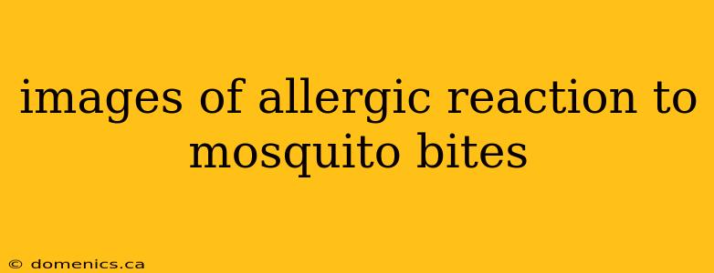 images of allergic reaction to mosquito bites