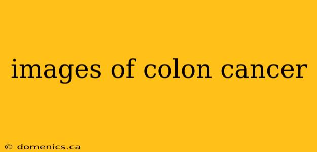 images of colon cancer