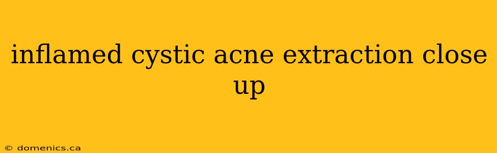 inflamed cystic acne extraction close up