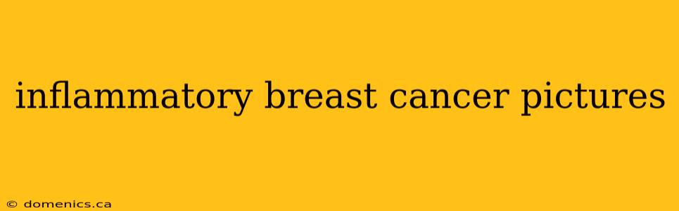 inflammatory breast cancer pictures
