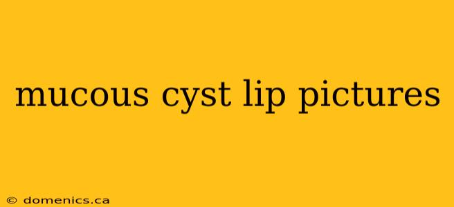 mucous cyst lip pictures