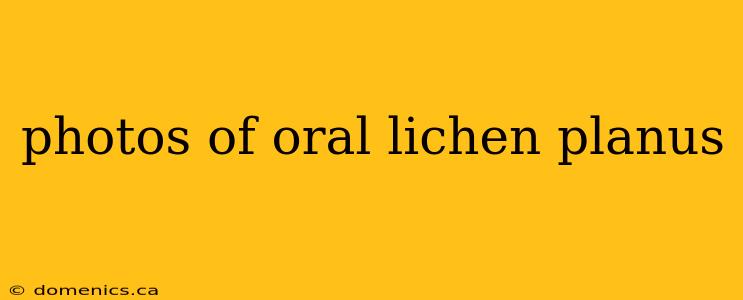 photos of oral lichen planus