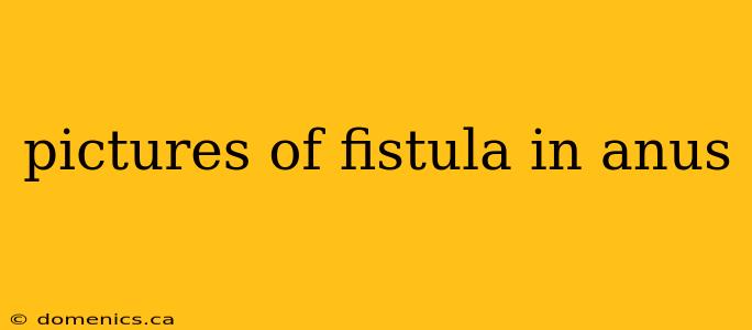 pictures of fistula in anus