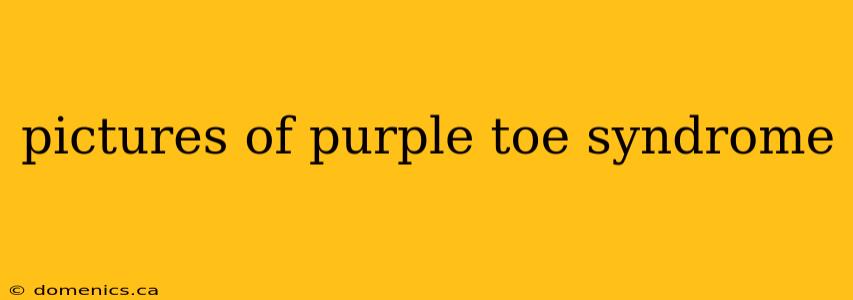 pictures of purple toe syndrome