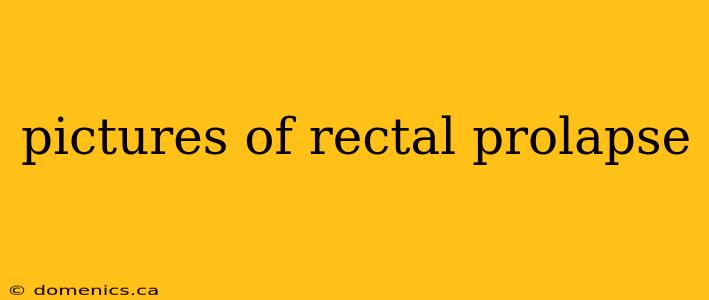 pictures of rectal prolapse