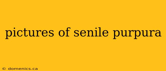 pictures of senile purpura