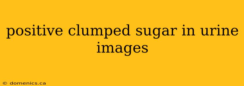 positive clumped sugar in urine images