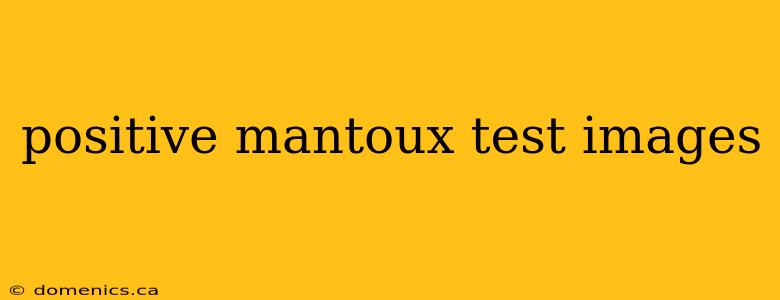 positive mantoux test images