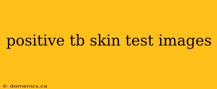 positive tb skin test images