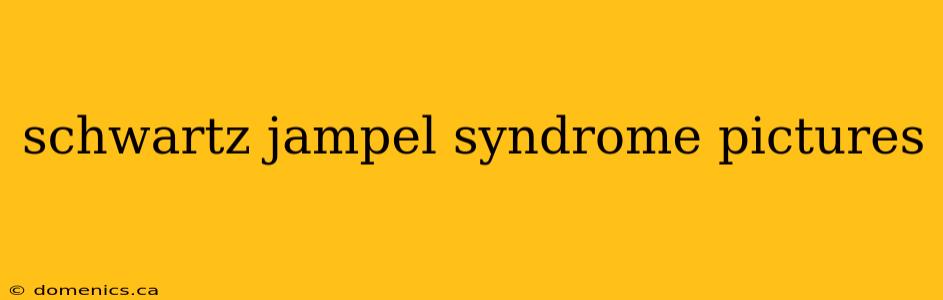 schwartz jampel syndrome pictures