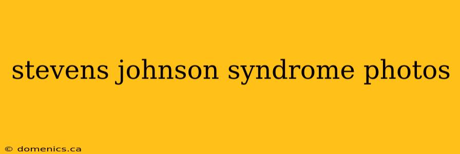 stevens johnson syndrome photos