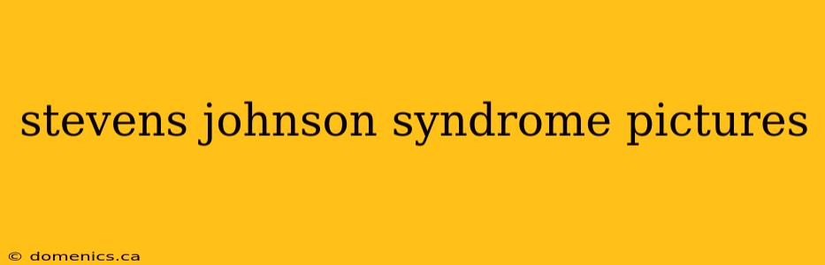 stevens johnson syndrome pictures