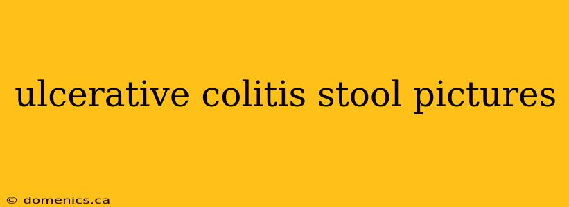 ulcerative colitis stool pictures