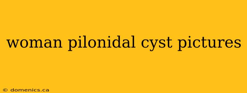 woman pilonidal cyst pictures